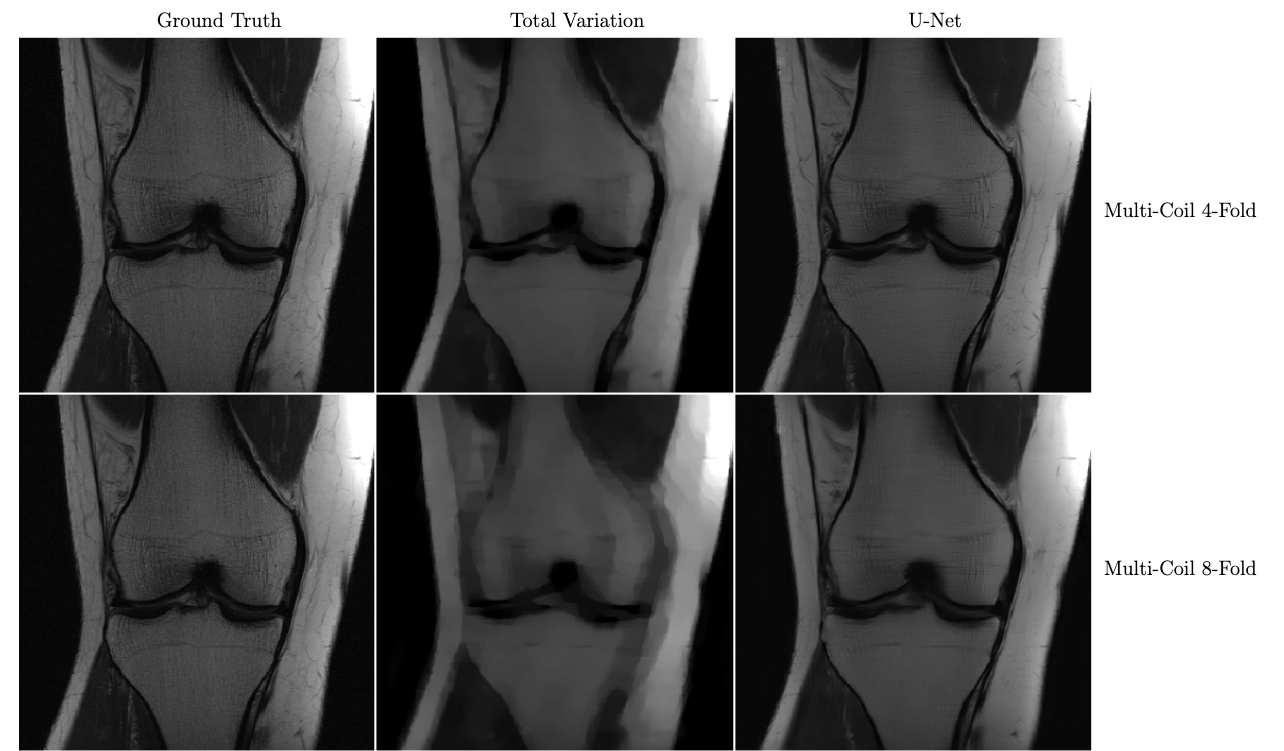 Knee MRI reconstructions comparison between compressed sensing with total variation regularization and the fastMRI U-Net baseline. The data is acquired using multiple coils at 4x and 8x subsampling. Reproduced from Zbontar et al. 2018.