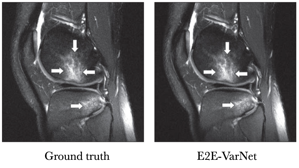 Knee MRI comparison between VarNet and the ground truth at 4x acceleration. Figure reproduced from Recht et al. 2020.